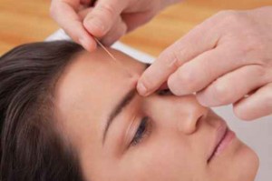 Acupuncture needles on head